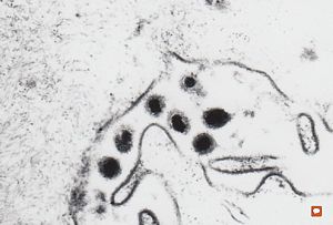 F,65y. | Epstein-Barr or cytomegaly virus - hairy leukoplakia - tongue